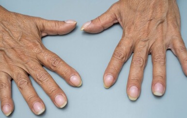 Batićasti prsti: Promjena na noktima koja može ukazivati na opasno stanje