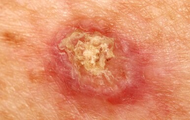 Planocelularni karcinom: Tihi rak koji počinje kao bezazlena ranica – prepoznajte ga na vrijeme