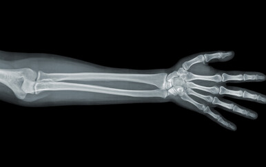 Novo istraživanje otkriva zabrinjavajuću vezu između vječnih kemikalija i zdravlja kostiju djece