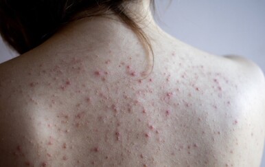 5 mjesta na tijelu gdje se mogu pojaviti akne i što učiniti u vezi s tim