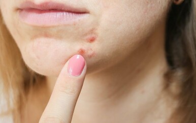 Akne na bradi: Većinom se javljaju kod odraslih osoba! Evo što ih uzrokuje i kako ih se riješiti