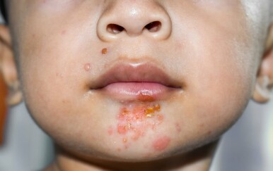 Impetigo: Prijenos, komplikacije i liječenje – sve je tu!