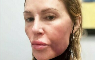 Brandi Glanville tvrdi da joj se lice raspada