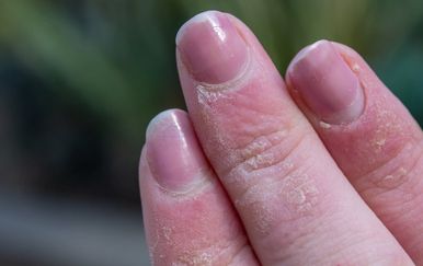 Pucanje kože oko noktiju na rukama: Zašto se problem stalno vraća i kako ga zaustaviti?