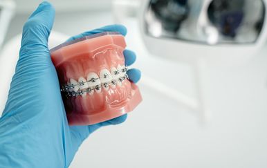 Nije svejedno koju boju gumice birate za aparatić za zube - neke će zube učiniti žućima, a neke bjeljima