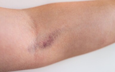 Kako prepoznati tromb u ruci? Ova 4 znaka ne smijete ignorirati