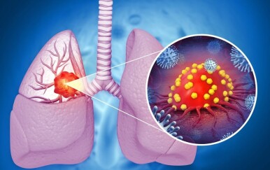 Tri puta više smrtnih slučajeva od raka pluća moglo bi se spriječiti ovim jednostavnim korakom!