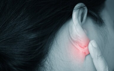 Dermatitis uha: Je li kriv nakit, slušalice ili gljivice? Evo kako prepoznati pravi uzrok!