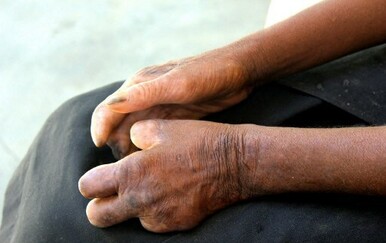 U Hrvatskoj potvrđen slučaj gube!