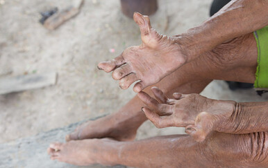 KBC Split: Radnik iz Nepala s dijagnozom gube na kućnom liječenju