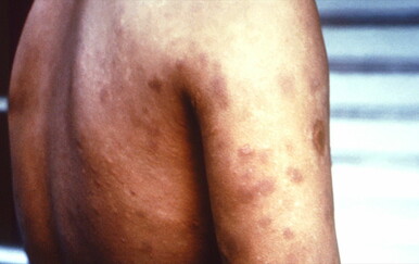 Liječnici smiruju nakon potvrđenog slučaja gube, ali iz KOHOM-a upozoravaju: "Ne procjepljuju se..."