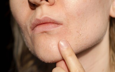 Po zimi vam koža postane suha? 10 načina kako to spriječiti