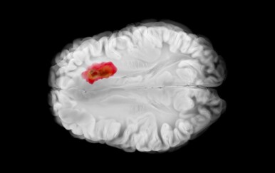 Znanstvenici šokirani: Stari lijek za tlak mogao bi usporiti jedan od najopasnijih tumora mozga!