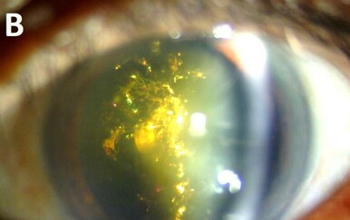 Rijetka bolest očiju čini da svjetlucaju poput božićnog drvca