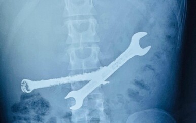 Muškarac progutao 7 četkica za zube i dva metalna ključa