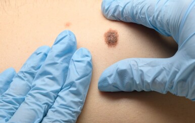 Ova navika gotovo utrostručuje rizik od najsmrtonosnijeg raka kože!