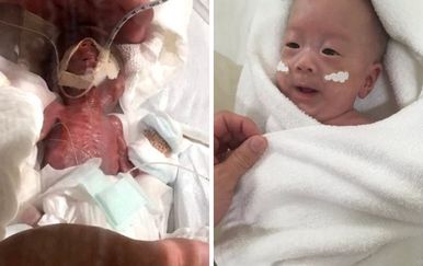 Dječak star pet dana (lijevo) i pri izlasku iz bolnice u veljači (desno) (Foto: Keio University Hospital)