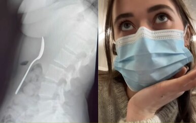 Bizarna nezgoda ostavila joj žlicu u želucu, a za sve je kriv pas