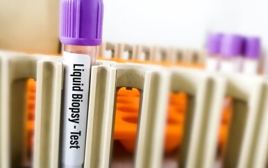 Tekuća biopsija: Jednostavna pretraga koja može otkriti rak bez invazivnih zahvata