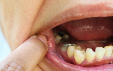 Crna plomba na zubu: EU je zabranjuje! Evo zašto biste je trebali zamijeniti što prije