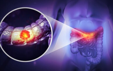 Čak 91 % veći rizik od raka debelog crijeva: Ova navika može vas skupo stajati!