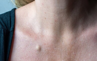 Ciste na koži: Zašto nastaju i kada ih je potrebno ukloniti?