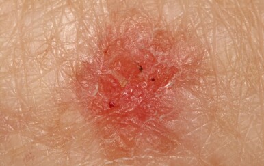 Karcinom in situ: Koje je značenje? Evo što trebate znati