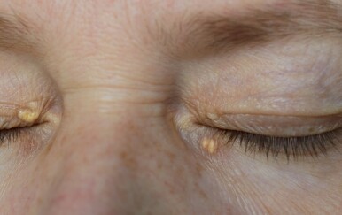 Simptomi bolesti jetre na koži: Ako imate neku od ovih 9 kožnih promjena, obavezno provjerite jetru!