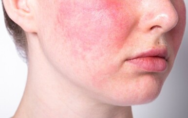 Zima i rozaceja: 6 pogrešaka koje vam crvene lice više nego ljetno sunce