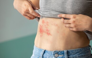 Većina ljudi ne zna ovo o herpes zosteru, a posljedice mogu trajati godinama