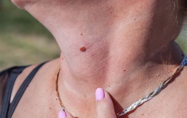 Simptomi raka kože: Ako primijetite ovih 7 promjena, javite se dermatologu