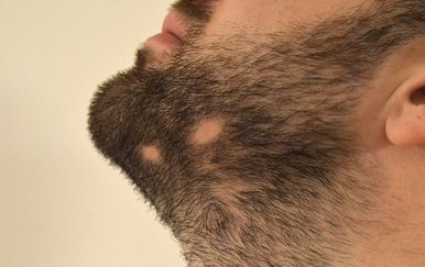 Alopecija brade: Zašto nastaje i može li se dlaka ponovno vratiti?
