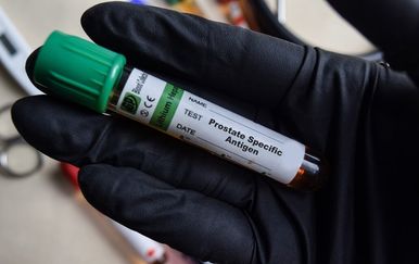 Novi test za rak prostate otkriva više opasnih slučajeva od PSA testa