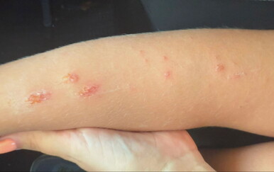 Što treba znati o impetigu koji se širi među djecom
