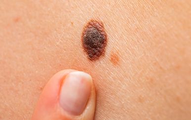 Madež koji svrbi: Evo kada je riječ o običnoj iritaciji, a kada o melanomu