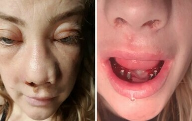 Britanka u agoniji nakon ugradnje implantata