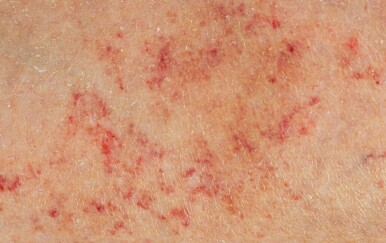 Meningokokna sepsa: Koji su simptomi bakterije koju nosi jedan od 10 ljudi?