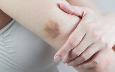 Modrice po tijelu mogu biti znak ozbiljne bolesti? Evo kada morate liječniku
