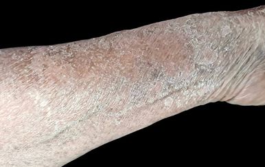 Pelagra bolest: Nedostatak jednog vitamina može dovesti do demencije i ozbiljnih komplikacija
