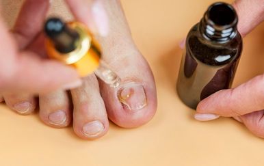 Gljivice na noktima (onihomikoza) i prirodno liječenje: Što zaista djeluje?