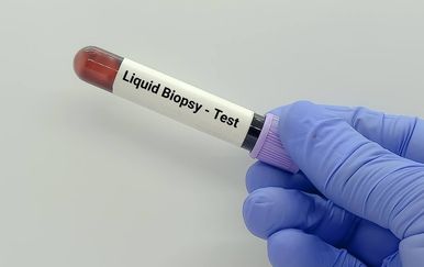 Tekuća biopsija: Krvna pretraga koja pomaže u ranijem otkrivanju raka pluća