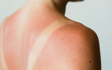 Zašto neki ljudi izgore na suncu već nakon 15 minuta, a drugi ne?