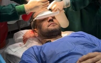 Sandi Pego na Instagramu pokazao kako izgleda cijeli proces transplatacije kose