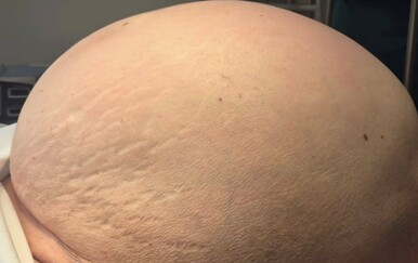 Liječnički tim gospićke bolnice odstranio tumor težak 36 kilograma