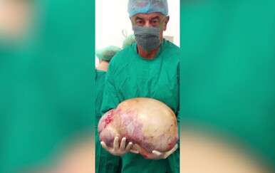 Veliki uspjeh: Pacijentici iz Gospića uklonjen tumor težak 36 kilograma!