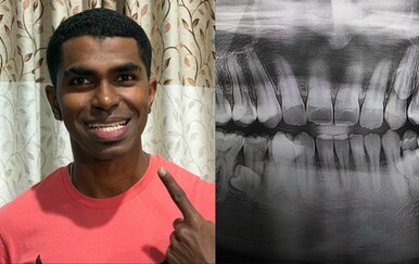 Muškarac iz Malezije ima 42 zuba, što je novi Guinnessov svjetski rekord