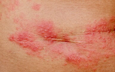 Herpes zoster ispod grudi: Ovo su prvi znakovi koje žene najčešće ignoriraju