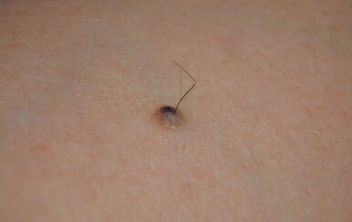 Raste li vam dlaka iz madeža? Evo što to zapravo znači (i kada je opasno!)