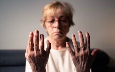 Reumatoidni artritis i životni vijek: 5 opasnih komplikacija koje mogu biti kobne