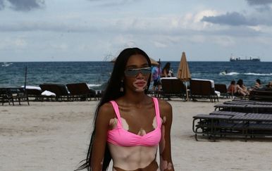 Winnie Harlow (Foto: profimedia)
